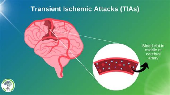 Tia Kemp Age: Understanding Transient Ischemic Attacks and Their Connection to Your Years
